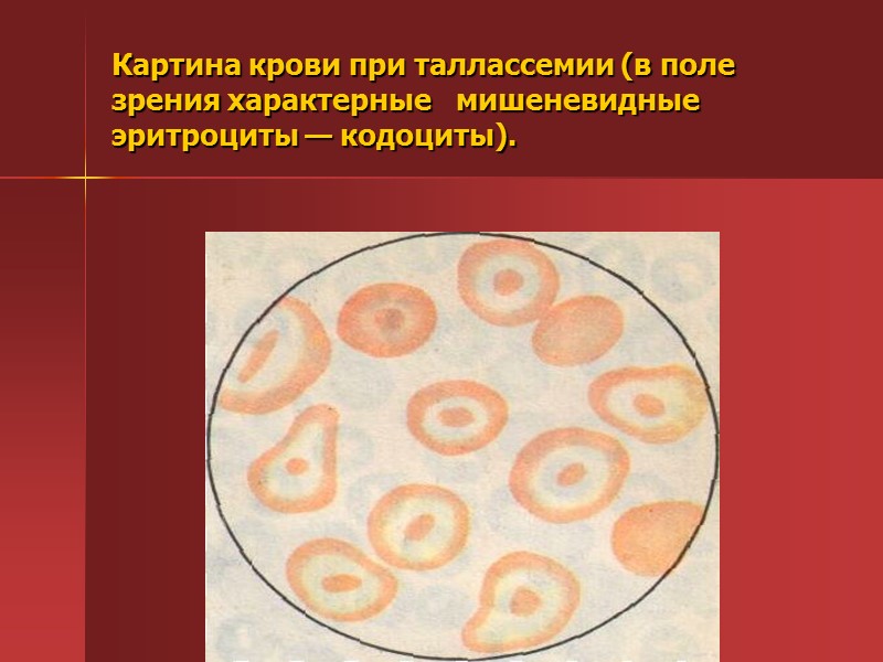 Лечение талассемии гемотрансфузии + прием десферала (во избежание развития гемосидероза); фолиевая кислота по Лечение талассемии гемотрансфузии + прием десферала (во избежание развития гемосидероза); фолиевая кислота по