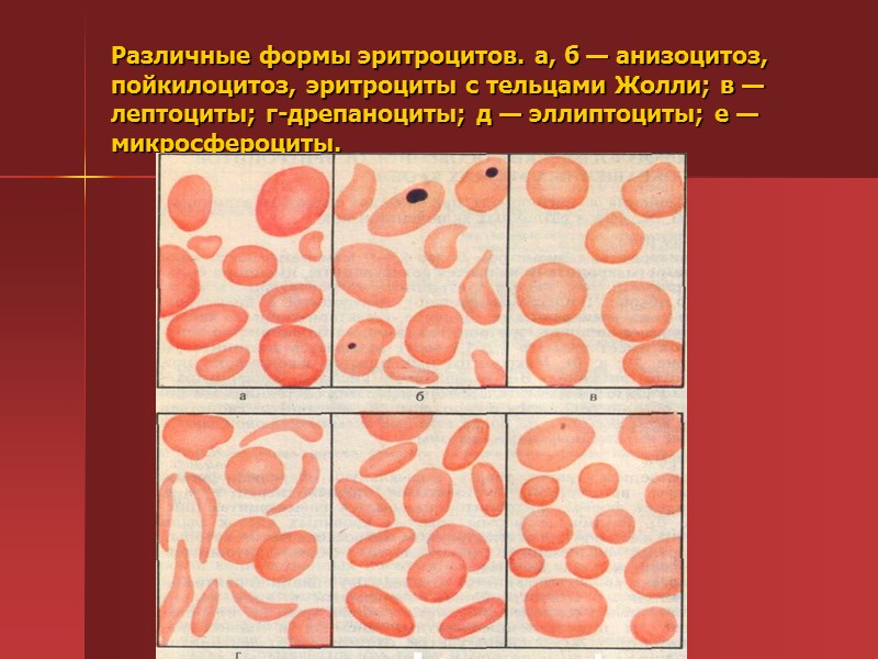 Пойкилоцитоз анемия. Пойкилоцитоз апластическая анемия. Пойкилоцитоз формы эритроцитов. Микроцитоз анизоцитоз пойкилоцитоз. Пойкилоцитоз анизоцитоз анемия.