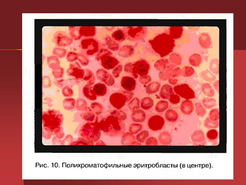 ДИАГНОСТИКА Общий анализ крови помогает установить снижение показателей гемоглобина и числа эритроцитов. В период ДИАГНОСТИКА Общий анализ крови помогает установить снижение показателей гемоглобина и числа эритроцитов. В период