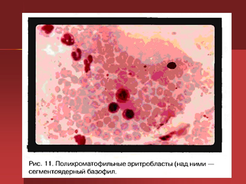 Мазки крови при В12-дефицитной анемии Мазки крови при В12-дефицитной анемии