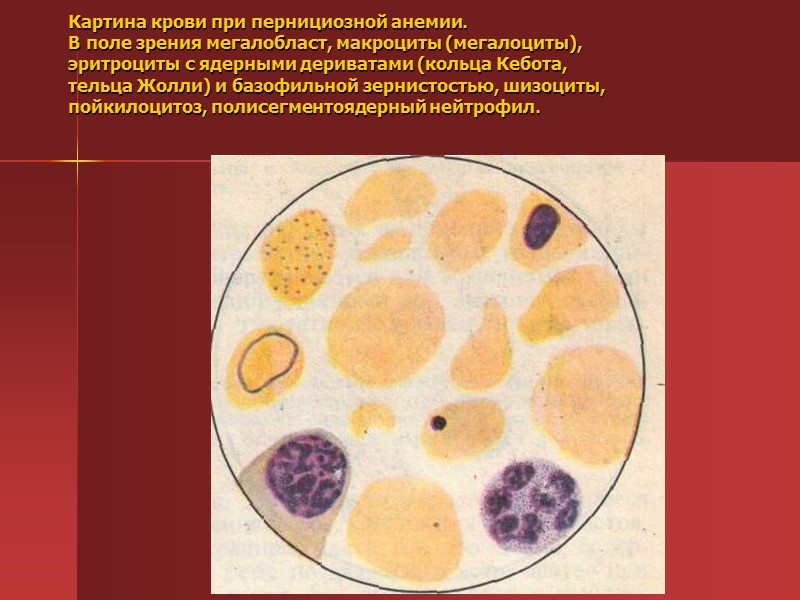 Анемия картина. Мегалобласты и мегалоциты. Нейтрофилы при пернициозной анемии. Макроциты и мегалоциты. Анизоцитоз пойкилоцитоз базофильная зернистость эритроцитов.