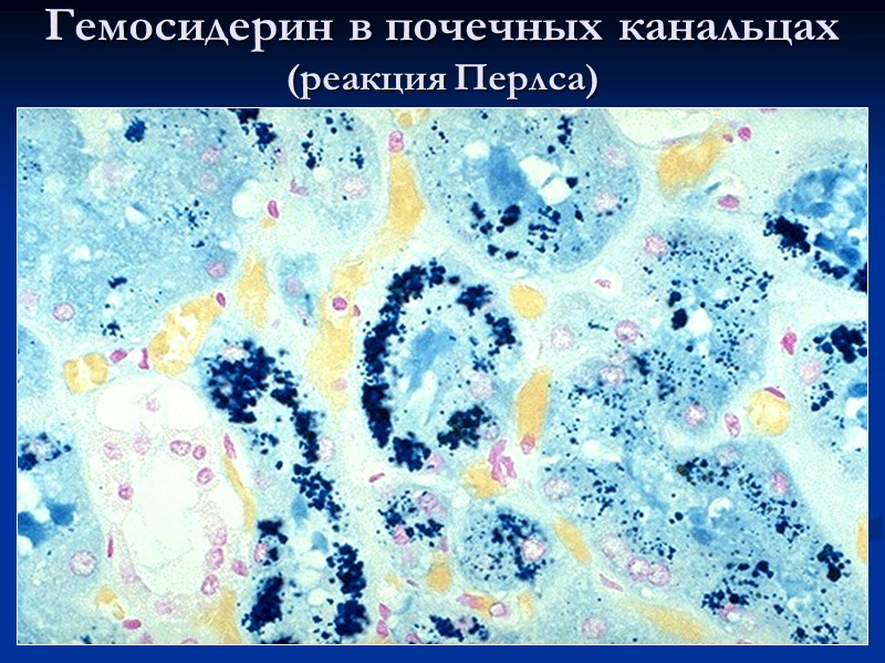 Смешанные дистрофии - это количественные и качественные структурные изменения, которые обусловлены нарушением обменных процессов,