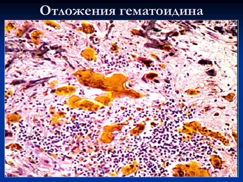 Гемосидерин в купферовских клетках печени (справа - реакция Перлса)