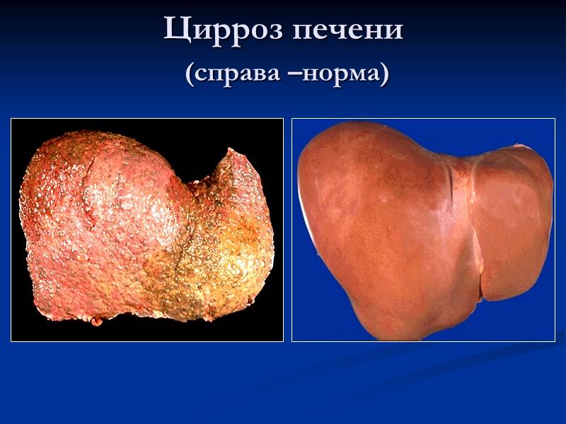 Соляно-кислый гематин на дне язвы желудка