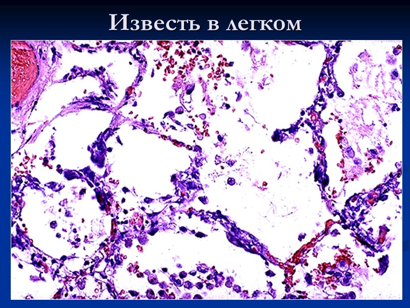 Подагра: соли мочекислого натрия