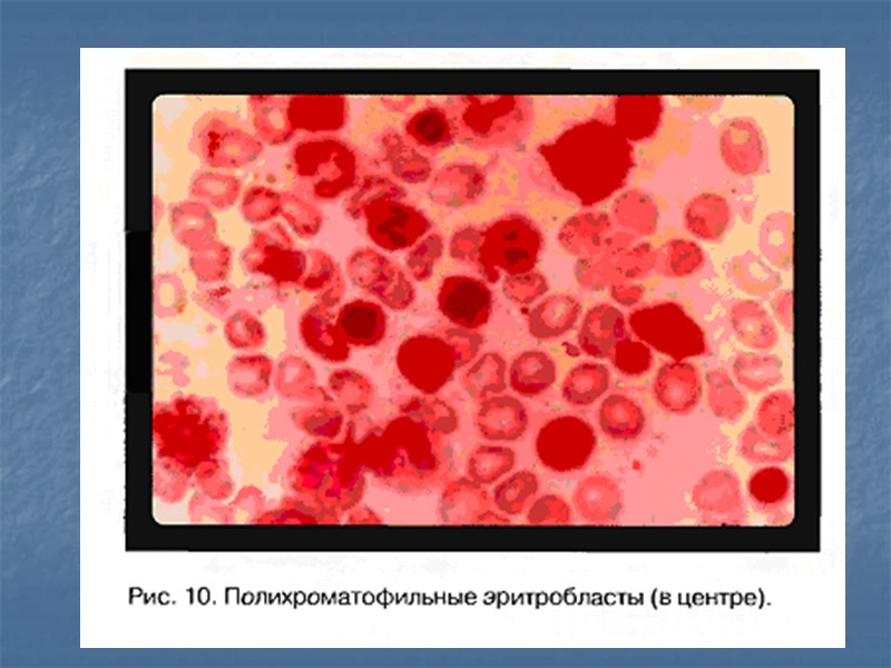 Клиника В12-дефицитной анемии складывается из: 1) циркуляторно-гипоксического (при достаточной выраженности анемии и кислородного голодания