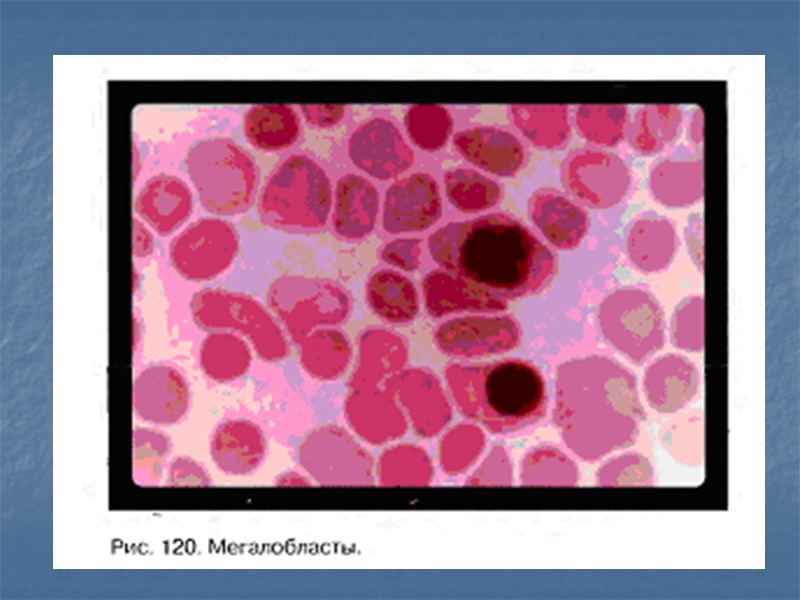 Мазки крови при В12-дефицитной анемии