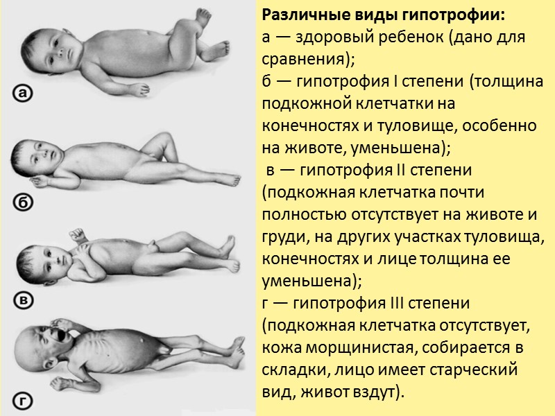 Нейроэндокринная форма: - значительное (обычно пропорциональное) снижение массы и длины тела с рождения (нанизм).