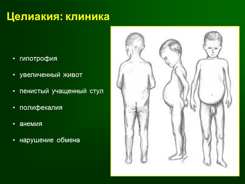 Синдром мальабсорбции (нарушенного всасывания)      Расстройство всасывания в тонкой кишке