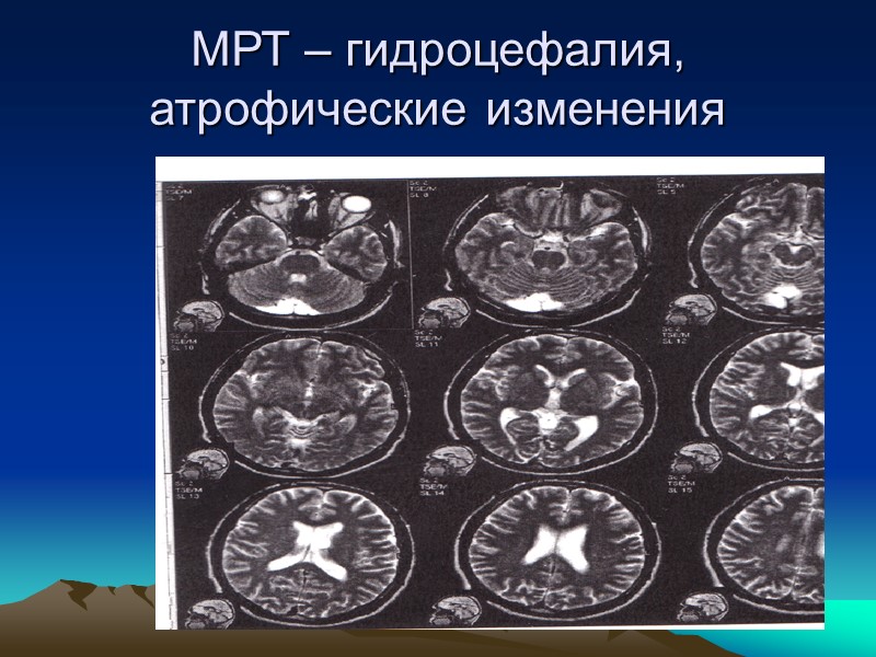 Клинические формы Брюшная форма Ригидно-аритмогиперкинетическая, или ранняя форма  Дрожательно-ригидная форма  Дрожательная форма