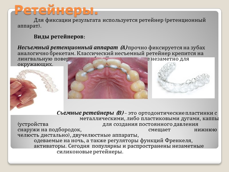 Брэкет-система.   Брекет - ортодонтическое устройство, которое фиксируется при помощи ортодонтического клея (бонда)