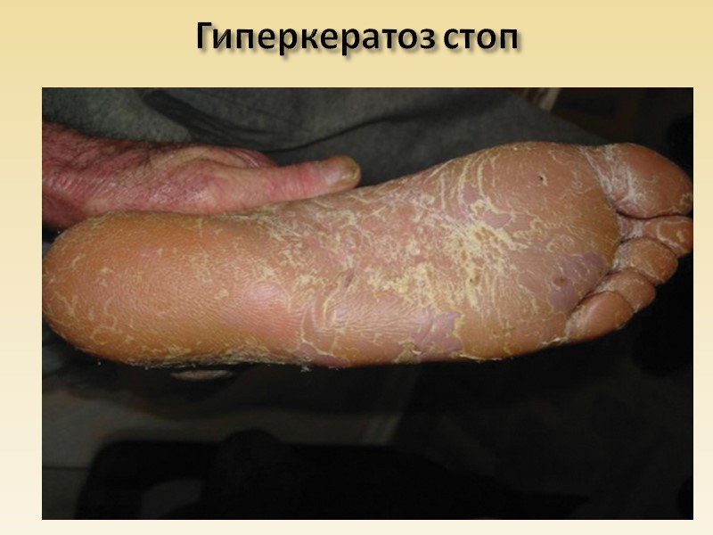 Зернистая дистрофия почек