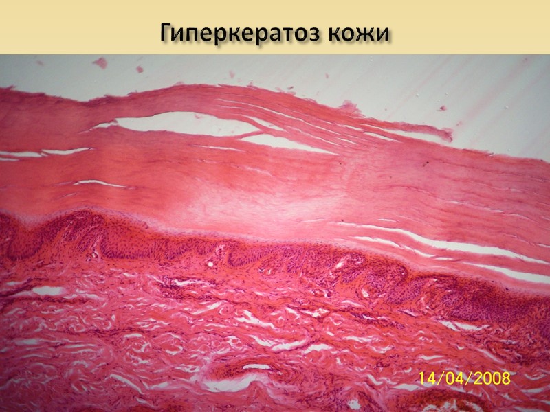 Алкогольный гиалин в печени