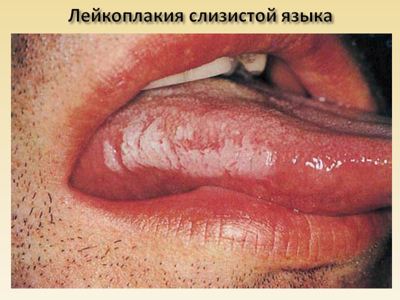 Гиалиново-капельная дистрофия почек