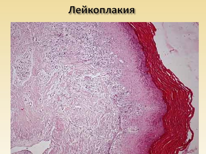 Гидропическая дистрофия почек