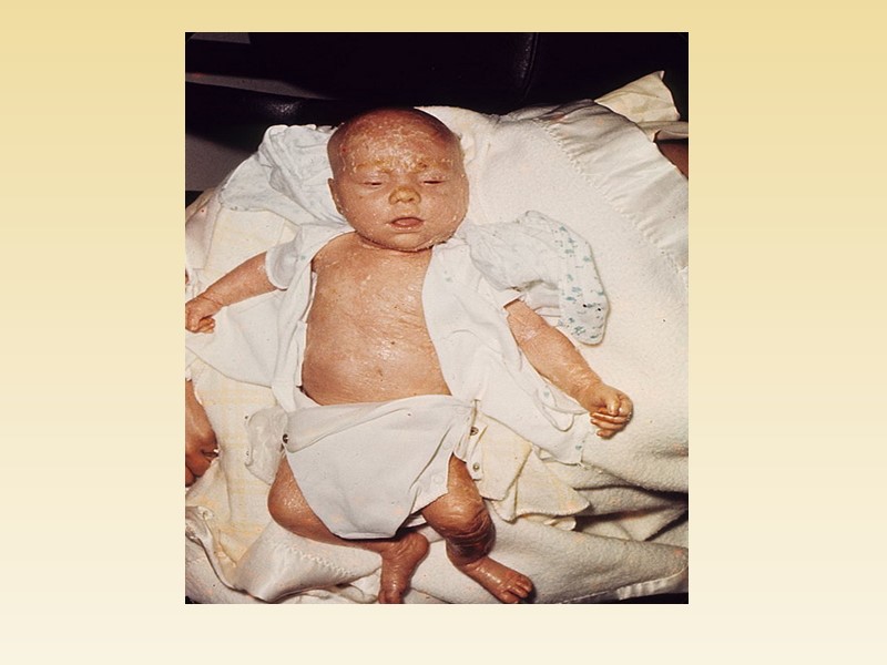 Роговая дистрофия: Локализация: кожа и слизистые оболочки; Причины: инфекции, воспаление, воздействие физических и химических