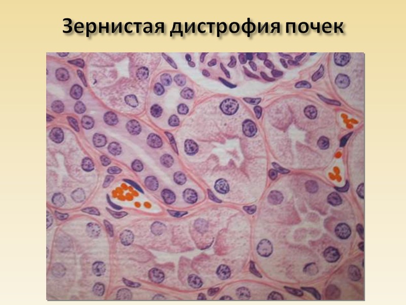 Дистрофия (от греч. dys – нарушение и trophо – питание) – это сложный патологический
