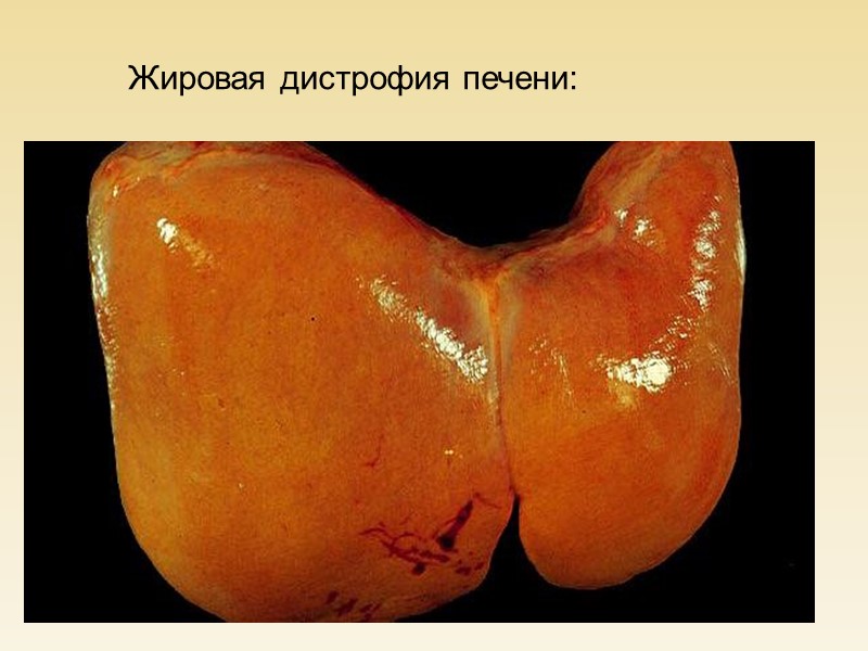 Лейкоплакия слизистой языка