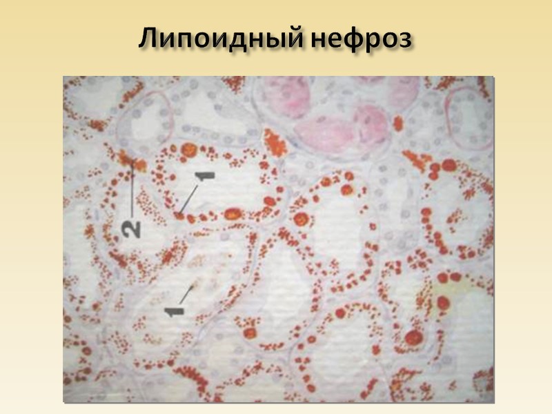 Жировая дистрофия печени: