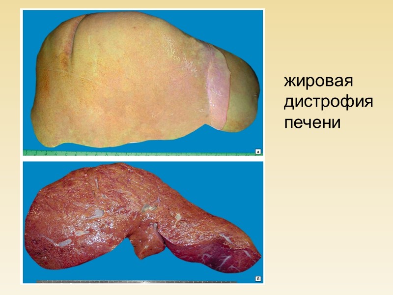 Нарушение обмена гликогена может быть: - Приобретенным  (при сахарном диабете) - Врожденным 
