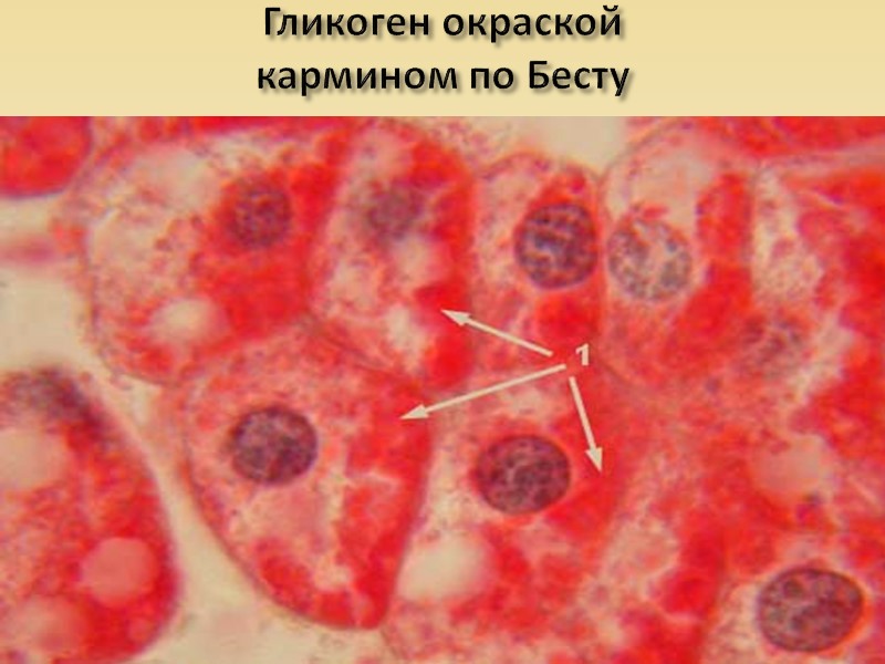Сахарный диабет характеризуется: -Патологией β-клеток островков поджелудочной железы, что ведет к недостаточной выработке инсулина,