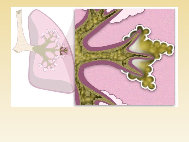 Диабетический гломерулосклероз