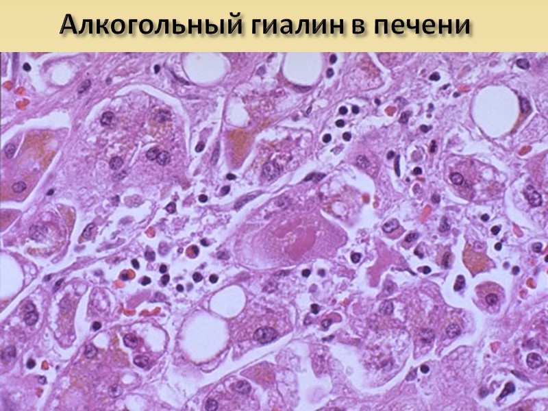 Декомпозиция (фанероз) – распад сложных в химическом отношении веществ. Распад липопротеидных комплексов и накопление
