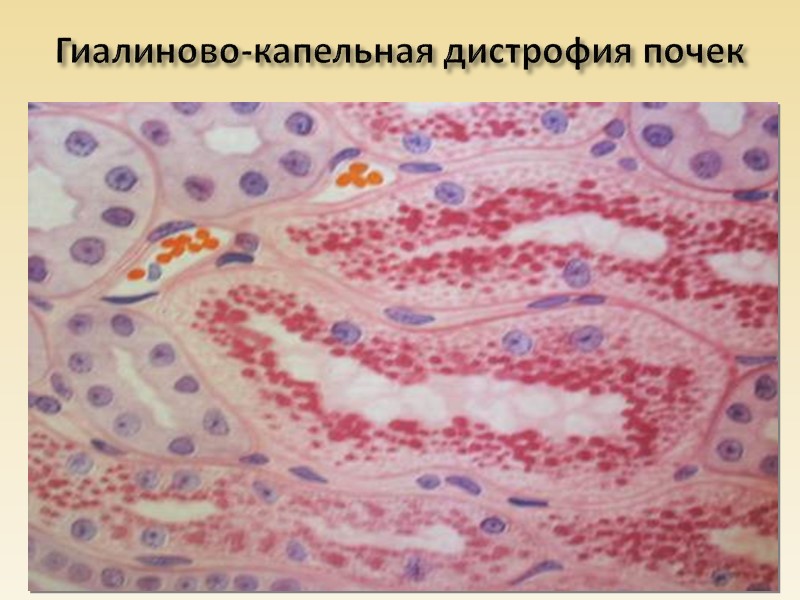 Классификация дистрофий.  В зависимости от локализации нарушений обмена:    паренхиматозные; 