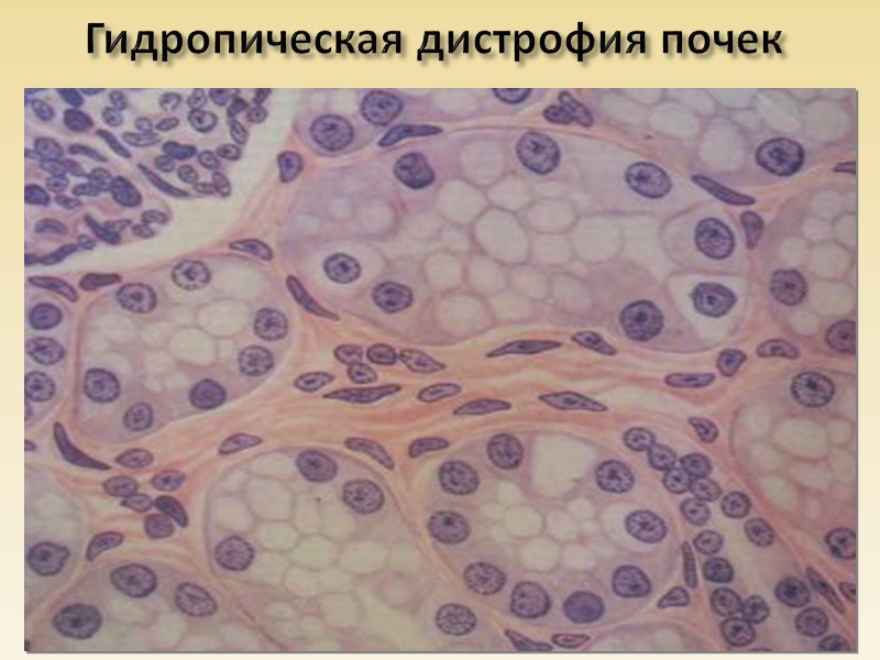 Паренхиматозные дистрофии    –       структурные изменения