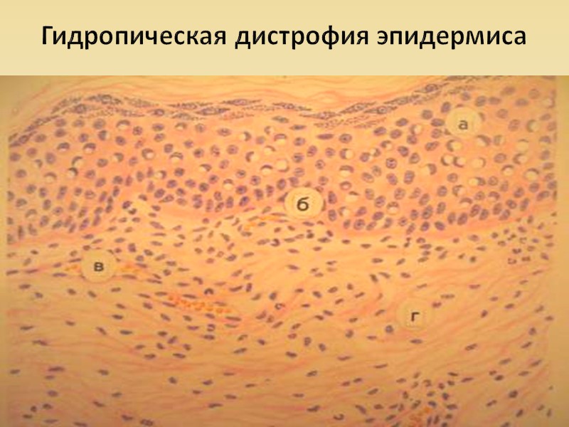 Приобретенные паренхиматозные белковые дистрофии: 1. Зернистая дистрофия 2. Гиалиново-капельная дистрофия 3. Гидропическая дистрофия 4.