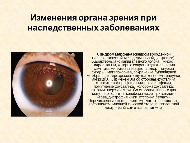 Изменения органа зрения при наследственных заболеваниях Синдром Марфана (синдром врожденной гипопластической мезодермальной дистрофии). Характерны