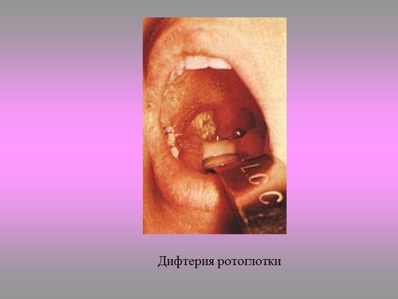 Токсинообразование C. diphtheriae продуцирует мощный экзотоксин – основной фактор патогенности. Нетоксигенные штаммы не вызывают