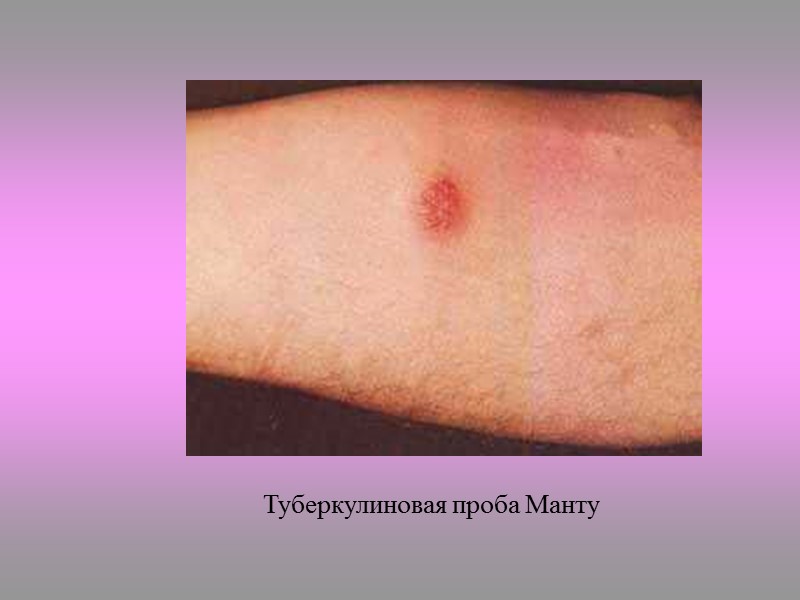 Микроскопия патологического материала В мазках окрашенных по Цилю-Нильсену, обнаруживают кислотоустойчивые палочки. Нередко материал содержит