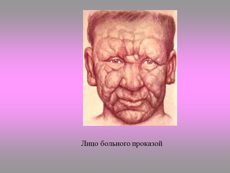 Эпидемиология Единственный резервуар – больной человек. Пути и механизмы передачи лепры остаются до конца