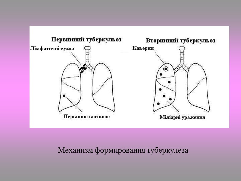 Mycobacterium tuberculosis в мазках из мокроты