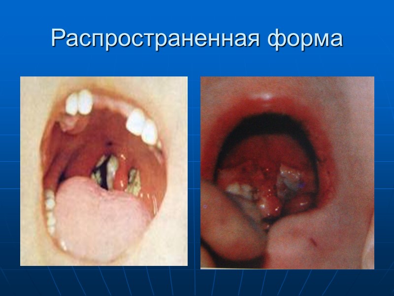 Основные стабильные биовары возбудителя: gravis, mitis и intermedius