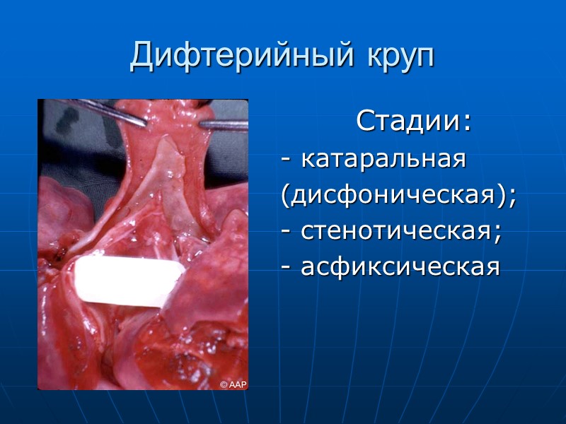 Особенности современного эпидемического процесса: - чаще болеют взрослые; - значительное количество больных с атипичными,