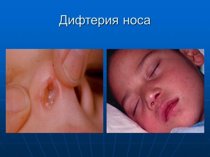 Местное действие            