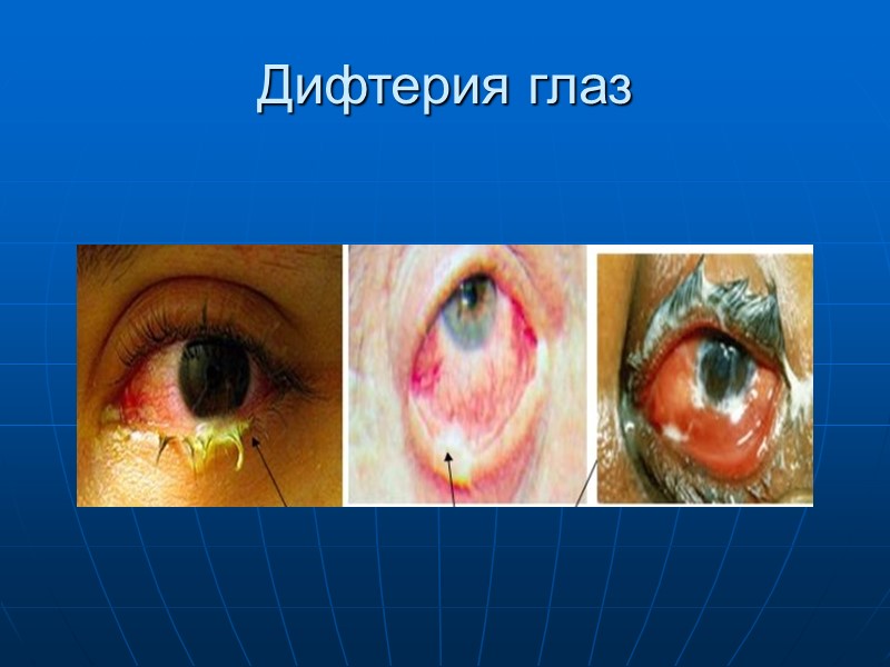 1. Дифтерия ротоглотки локализованная (катаральная, островчатая, плёнчатая) ;  распространённая; субтоксическая; токсическая (І, ІІ,