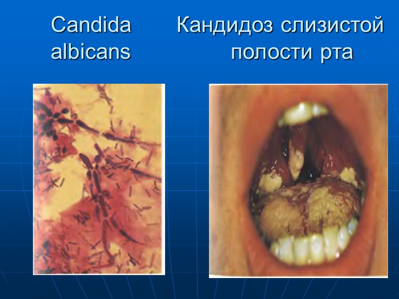 Осложнения инфекционно-токсический шок миокардиты,  моно- и полиневриты, включая поражения черепных и периферических нервов,