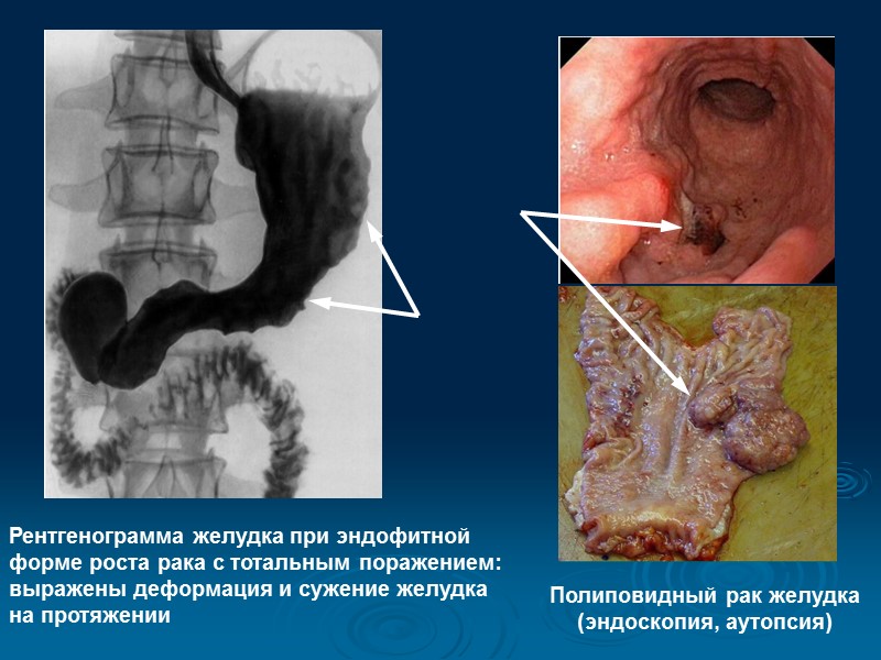 Диагностика язвенной болезни желудка и ДПК Сбор анамнеза Жалобы на болевой синдром (боли в