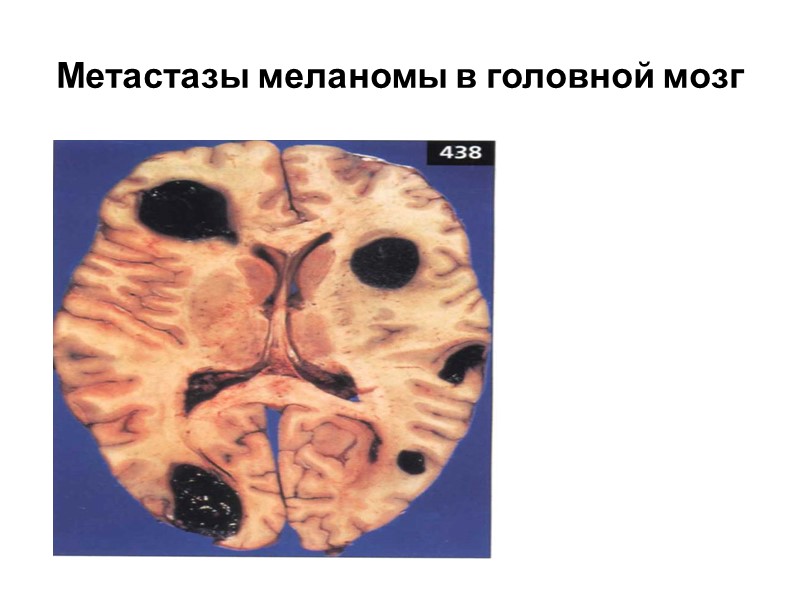 Нарушение обмена тирозиногенных пигментов Меланин – синтезируется в меланоцитах. Адренохром – пигмент в виде