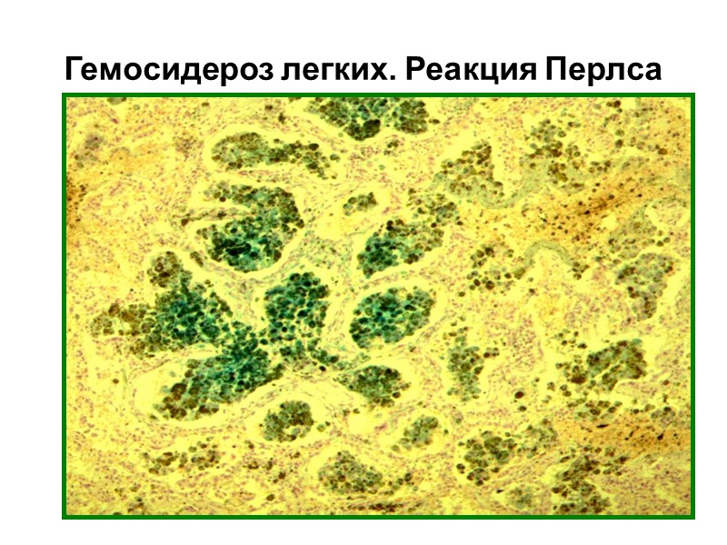 Нарушение обмена гемоглобиногенных пигментов Гемоглобиногенные пигменты:  ферритин, гемосидерин, билирубин (образуются и в норме)