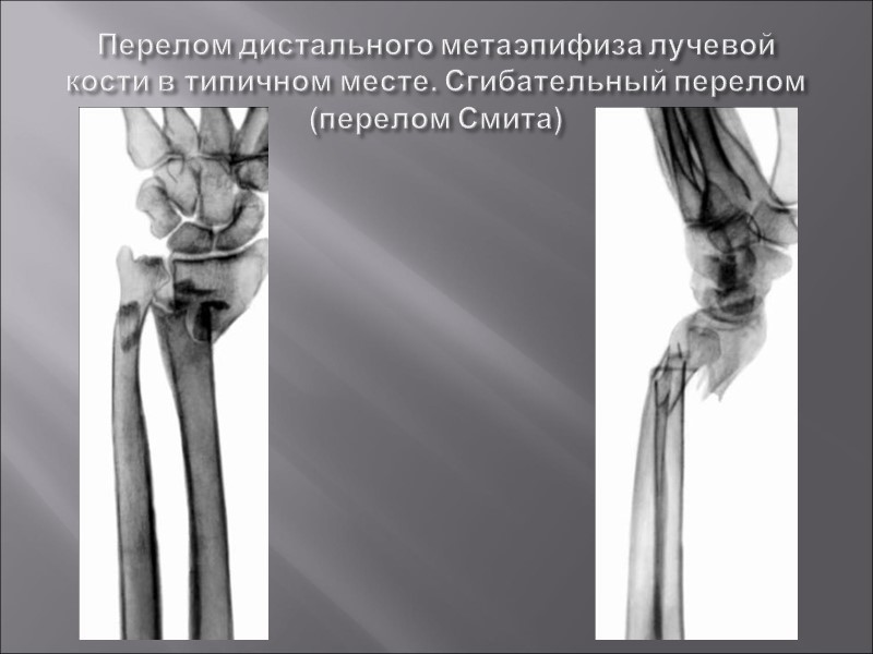 Перелом колеса и смита презентация