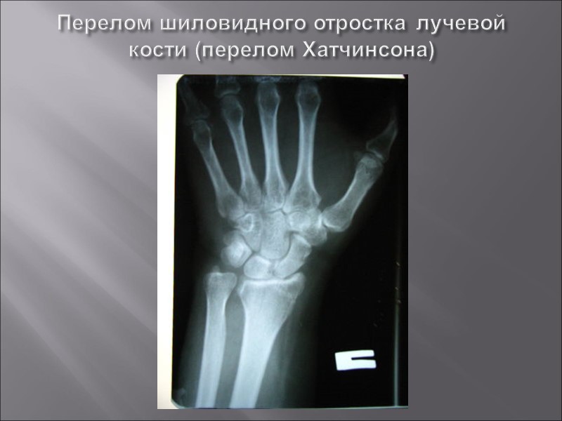 Лучевая кость на руке фото левой