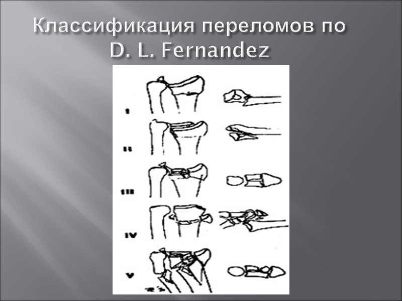 Закрытый оскольчатый внутрисуставной перелом тыльного края дистального метаэпифиза лучевой кости (перелом Бортона)