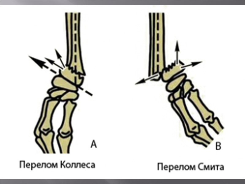 Механизм  1. Выхождение запястных костей из ниши в результате повреждения внутренней боковой связки.