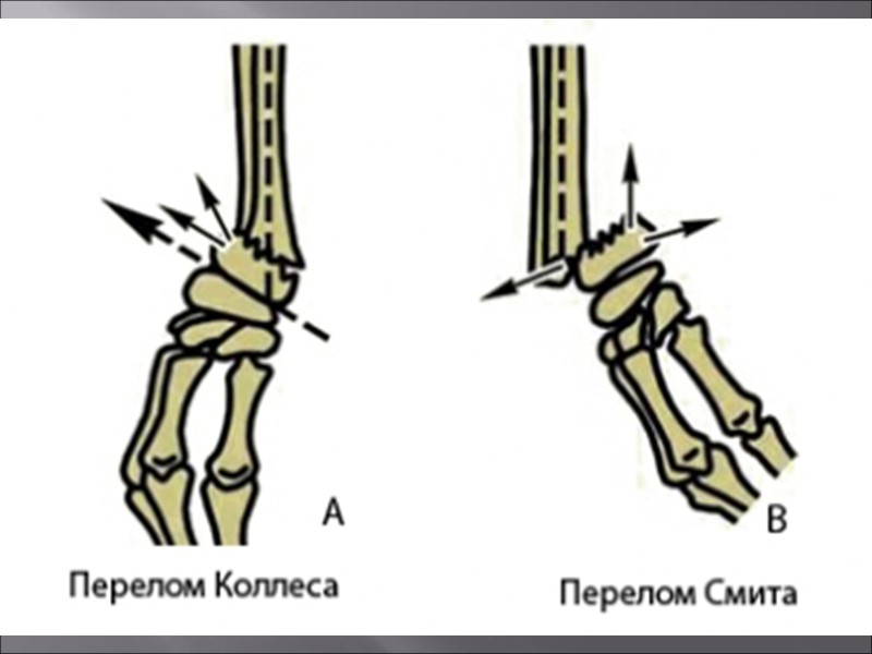 Перелом колеса и смита презентация