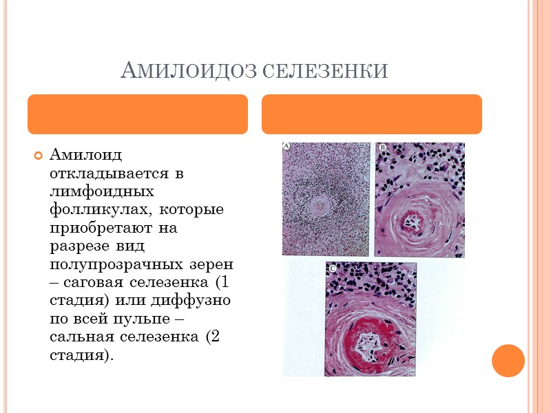 амилоидоз Характеризуется появлением в строме органов  и в стенках сосудов  не встречающегося