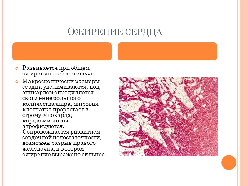 АМИЛОИДОЗ СЕРДЦА Амилоид обнаруживается под эндокардом, в строме и сосудах.  Сердце резко увеличивается